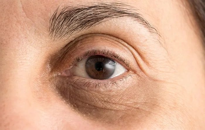 Cách trị quầng thâm mắt