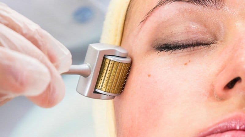 Lăn kim là một trong những phương pháp điều trị da khá phổ biến