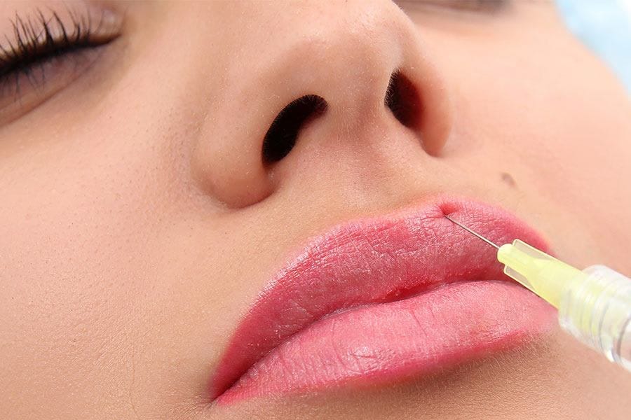 Tiêm filler môi đẹp và tự nhiên