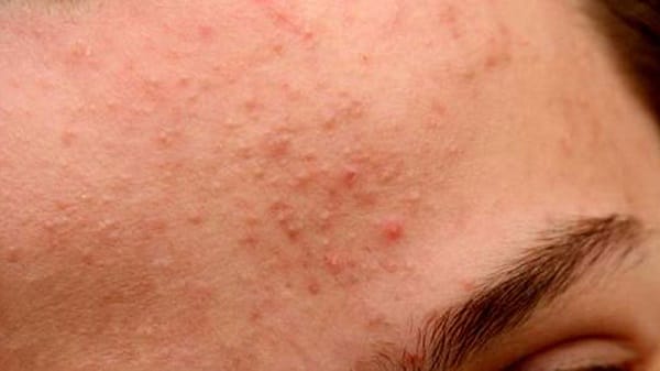 Mụn ẩn nằm dưới da, không sưng và đau