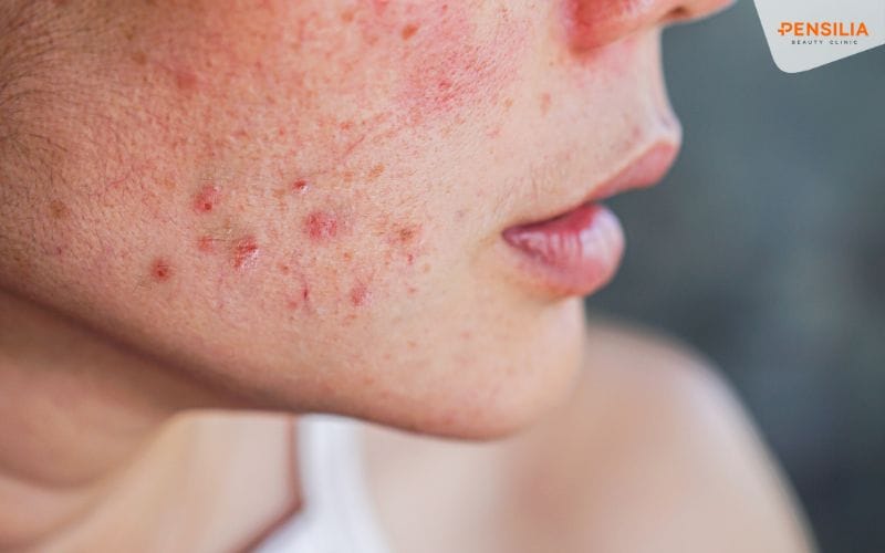 Trị sẹo mụn thâm