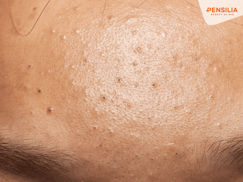 Mụn đầu đen là tình trạng rất thường gặp