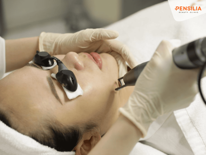 Trị nám bằng laser