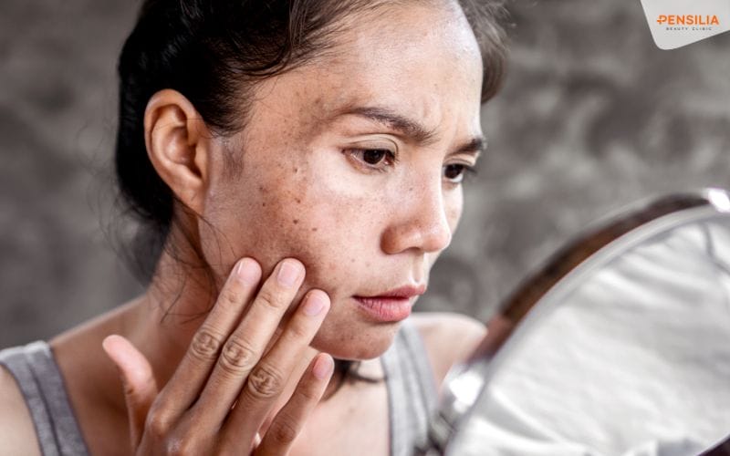 nỗi buồn mang tên nám da