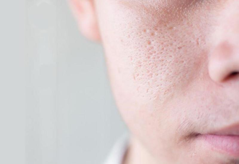 Điều trị sẹo lõm hiệu quả