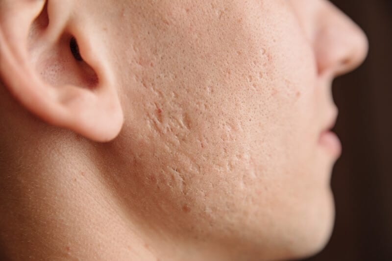 Xóa sẹo lõm tại Pensilia
