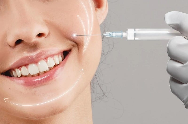 Tiêm chất làm đầy (filler) rãnh cười
