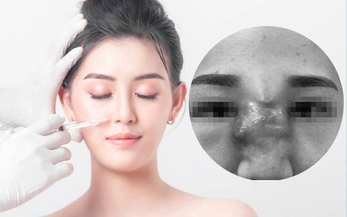 Tiêm filler và những biến chứng