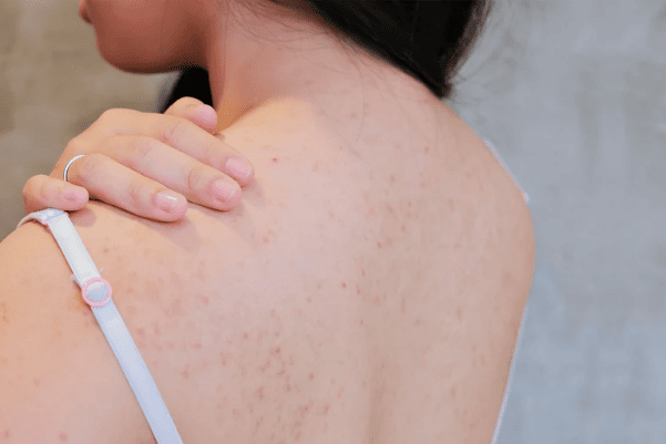 Trị mụn lưng hiệu quả