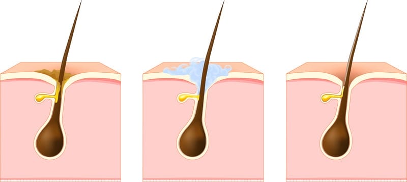 Tắc nghẽn lỗ chân lông gây ra các loại mụn