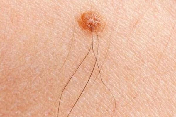 Nốt ruồi có lông có nguy hiểm không?