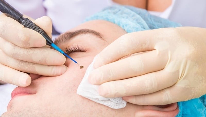 Xóa nốt ruồi liệu có thay đổi phong thủy?