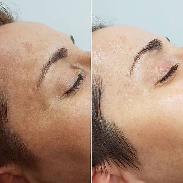 Điều trị nám da uy tín tại Pensilia