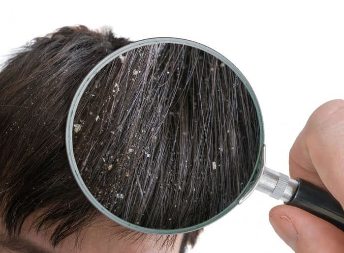 Gàu xuất hiện ở rất nhiều người