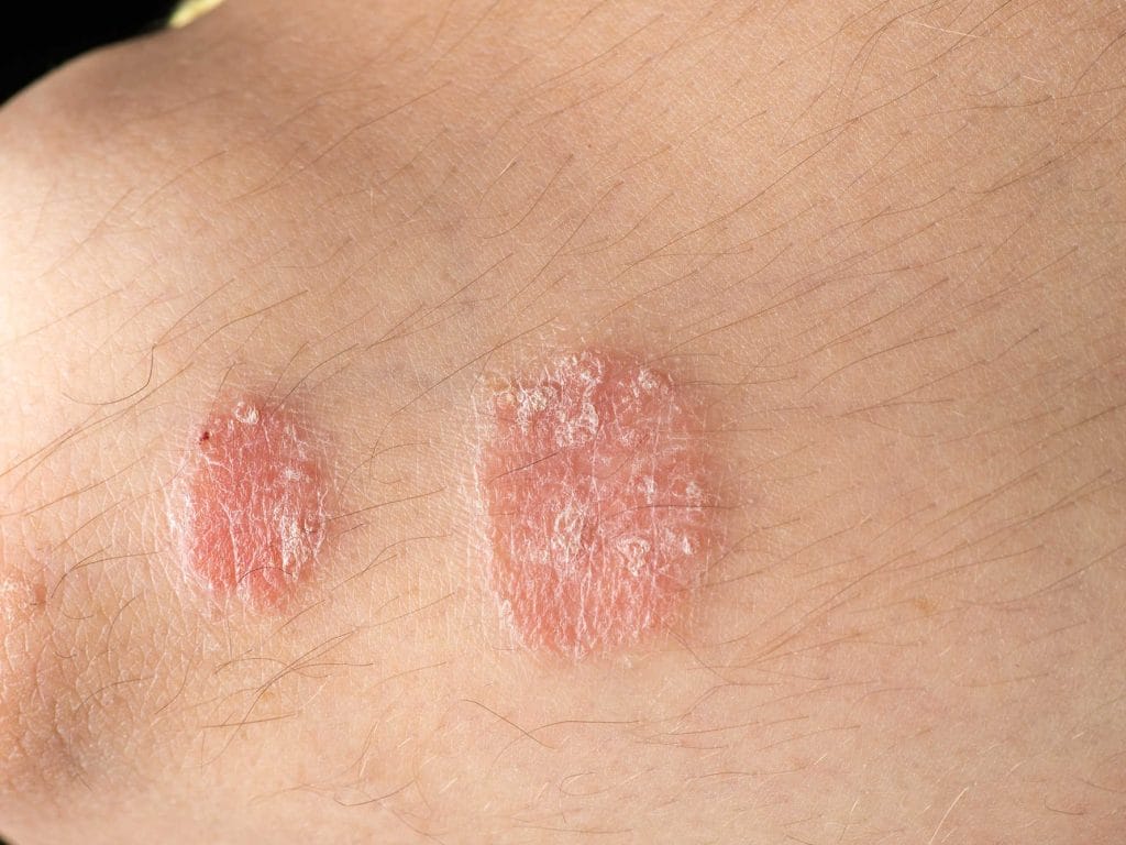 Bệnh vảy nến ở nam giới