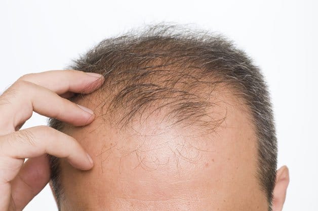 Bệnh hói đầu ở nam giới