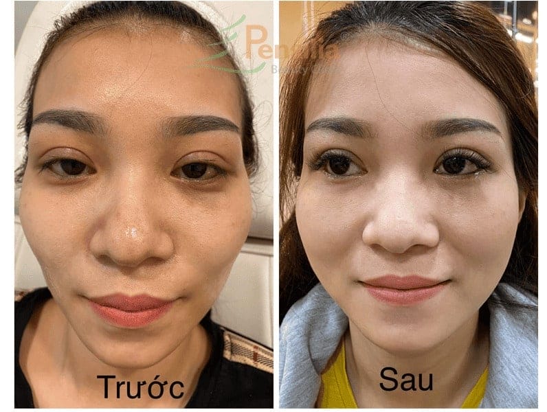 Tiêm filler trẻ hóa da tại Pensilia