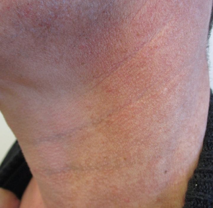 Bệnh lý Poikiloderma