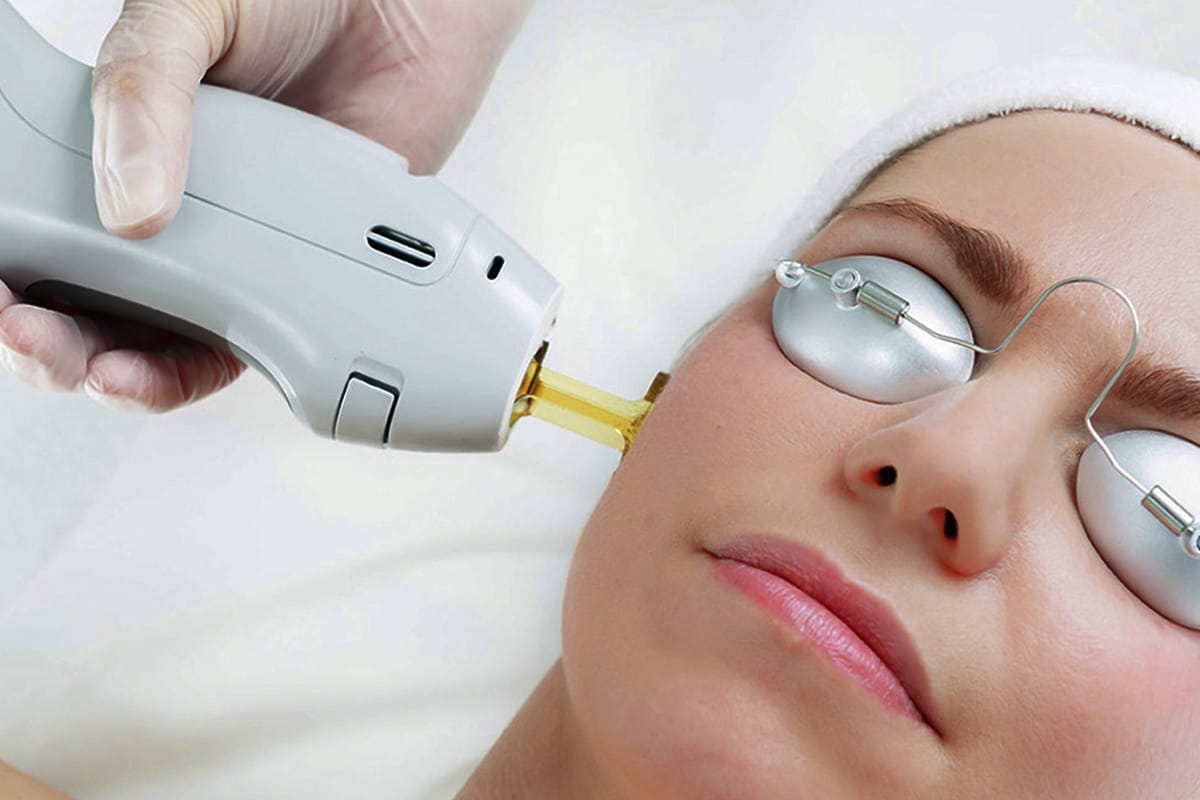 Laser Nd Yag điều trị nám tàn nhang