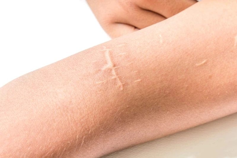 Bạn đã biết mình đang vấn đề sẹo gì không?