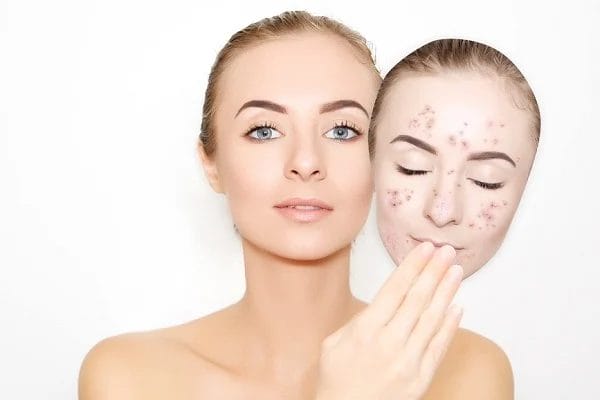 Đỏ da sau mụn và cách điều trị hiệu quả