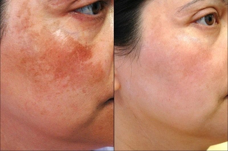 Điều trị nám tại Pensilia