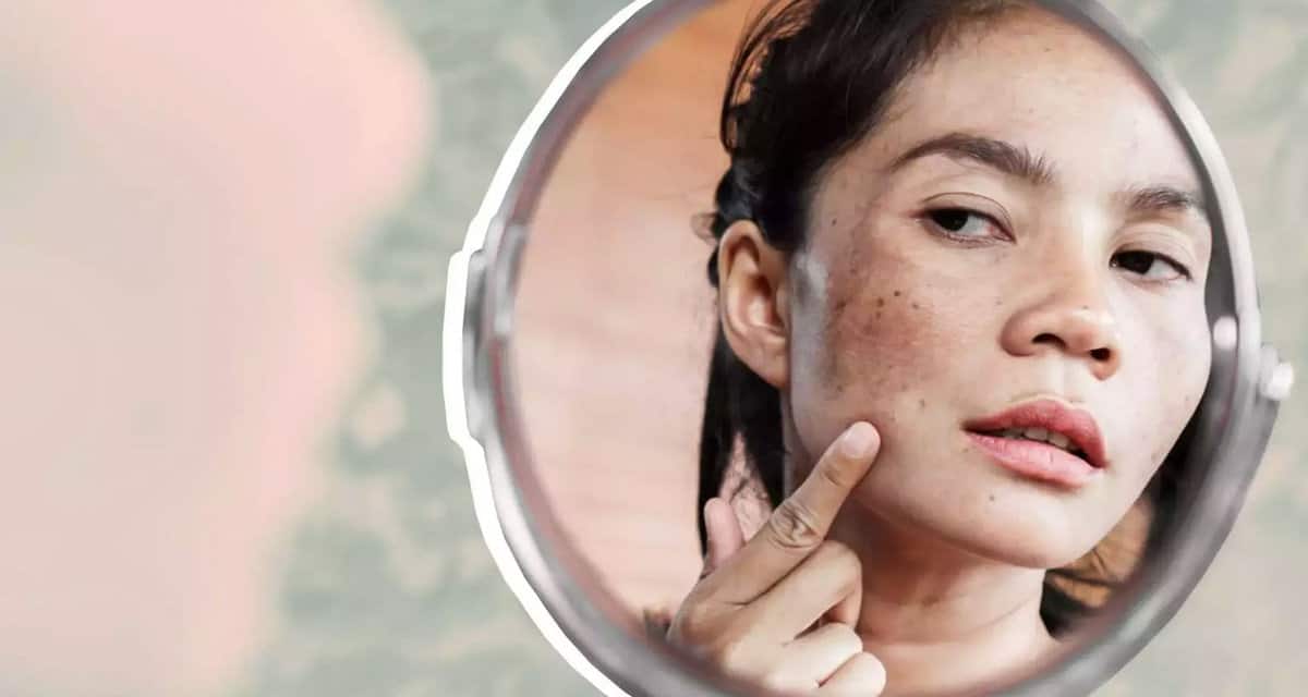 Nám da - tăng sắc tố da