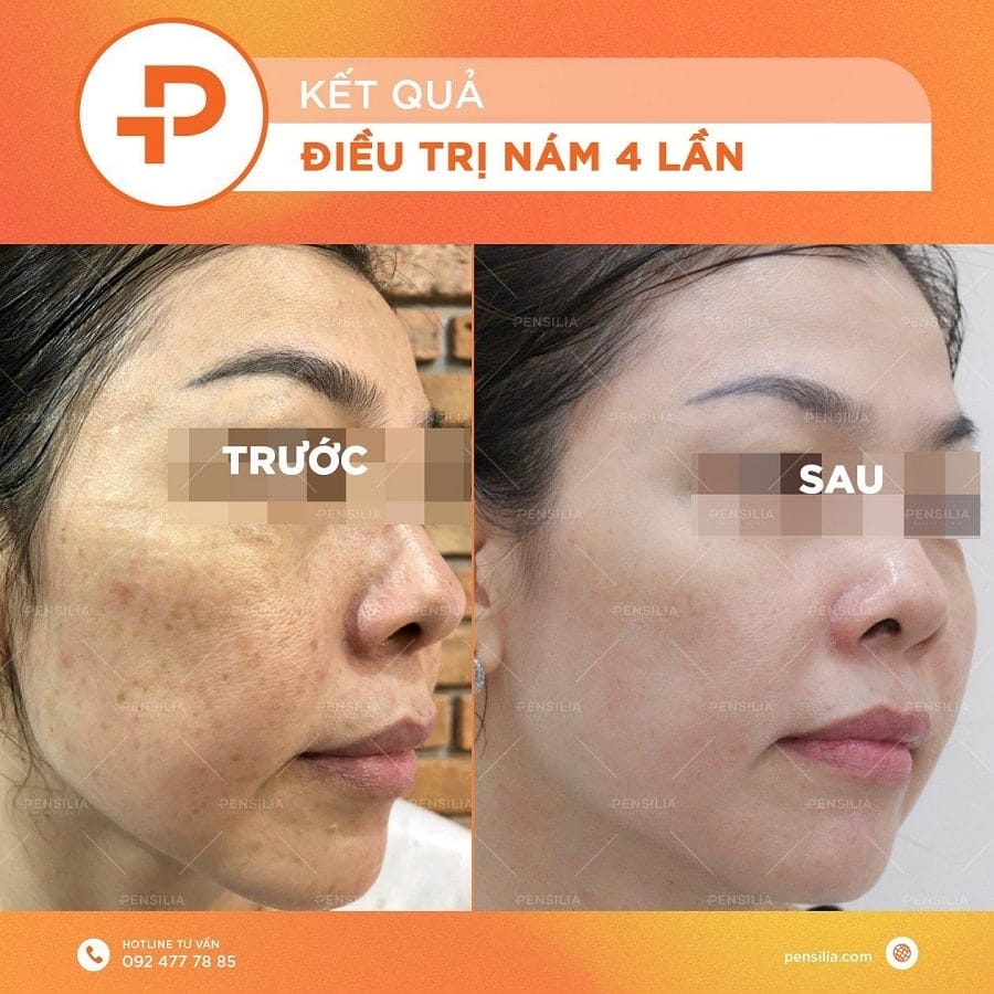 Bác sĩ CKII Da liễu Nguyễn Phương Thảo đã điều trị nám thành công cho nhiều khách hàng