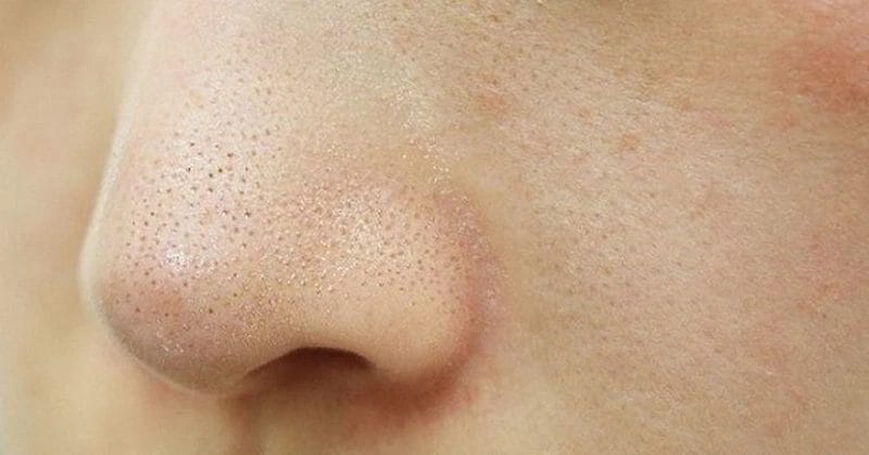 Sợi bã nhờn thường xuất hiện ở mũi, cằm