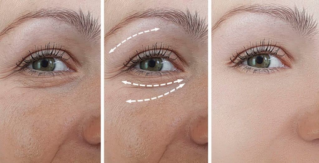 căng da bằng chỉ collagen