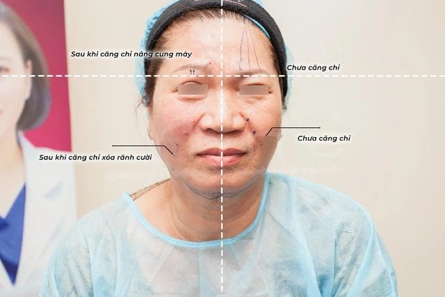 Hiệu quả căng da mặt bằng chỉ tại Pensilia