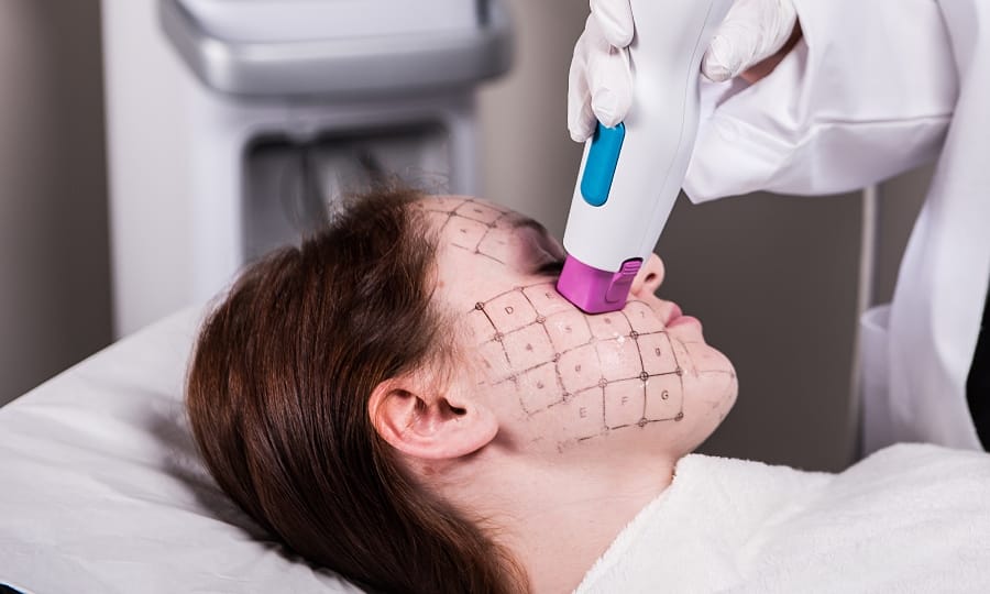 Hiệu quả nâng cơ, xóa nhăn công nghệ trẻ hóa thermage