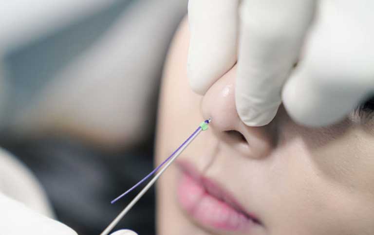 Nâng mũi bằng chỉ đẹp thanh thoát hơn