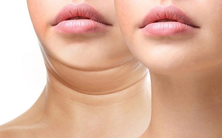 Nọng cằm khiến gương mặt kém phần thon gọn