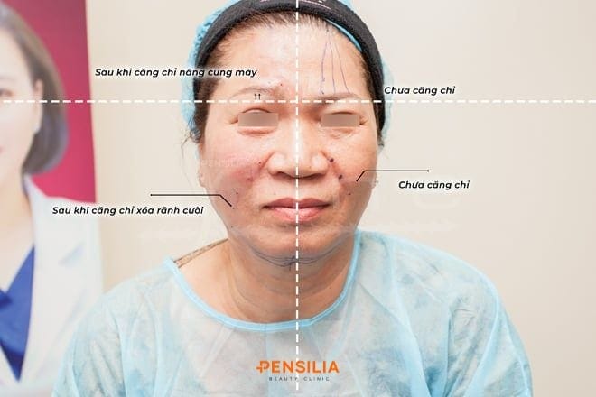 Nâng cung mày bằng chỉ collagen tại Pensilia