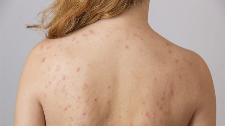 Mụn viêm, mụn đầu đen,...là những loại mụn thường thấy ở lưng