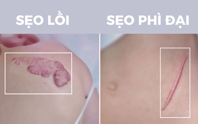 Sẹo lồi và sẹo phì đại