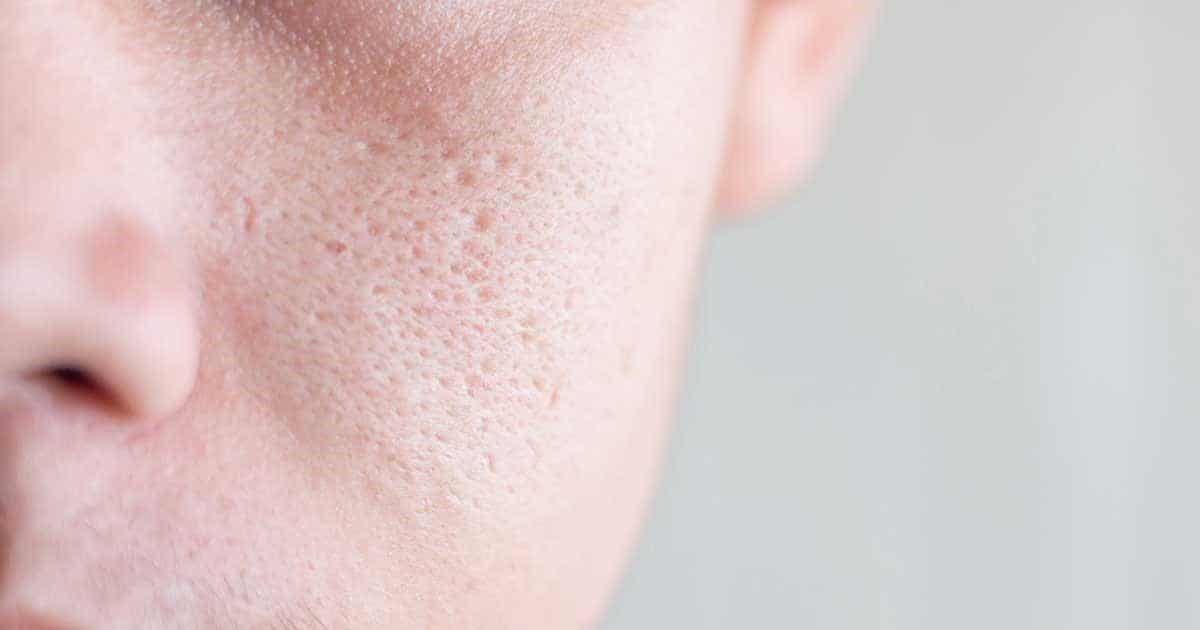 Top lưu ý sau điều trị sẹo