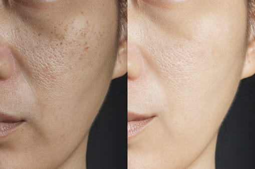 Công nghệ tái tạo màng đáy điều trị lỗ chân lông to