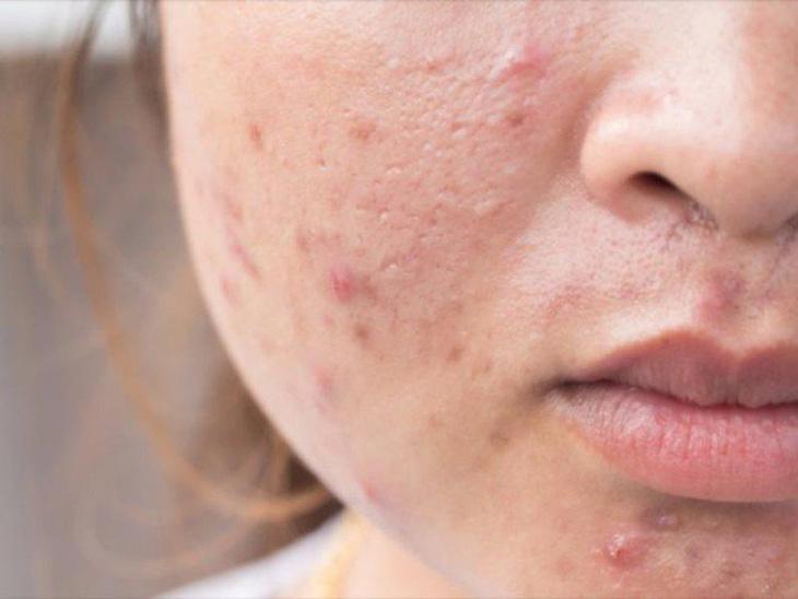 Tình trạng mụn viêm không chữa trị sẽ tổn thương da rất nhiều