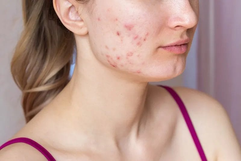 Sẹo đỏ do mụn để lại
