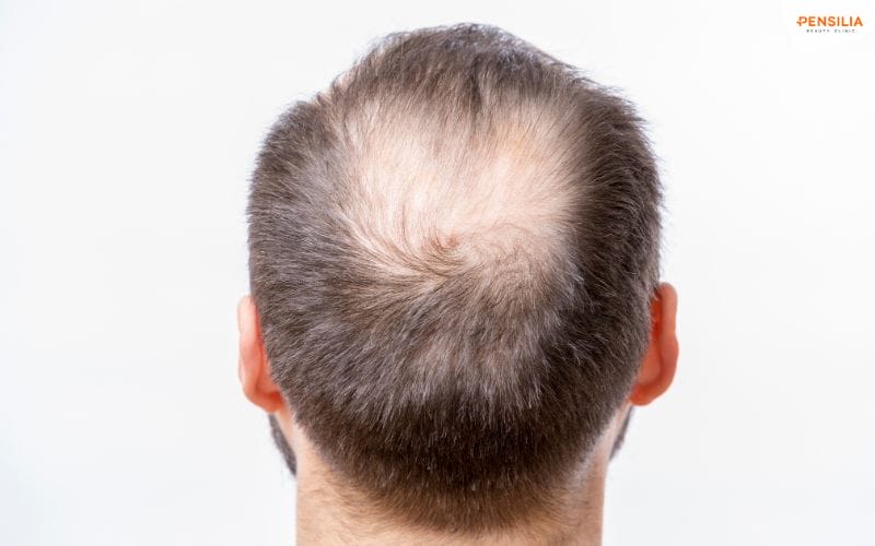 Pen hair trị rụng tóc