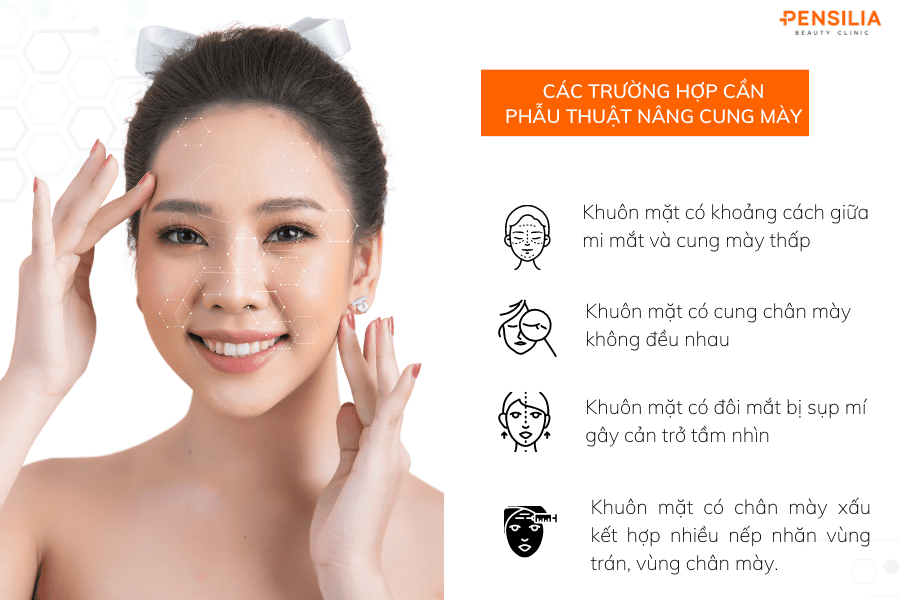 Phẫu thuật nâng cung mày