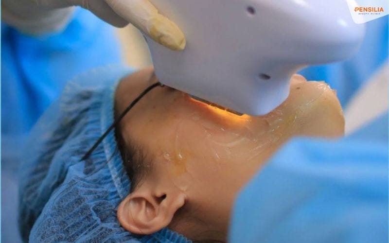 Elight trị thâm sau mụn