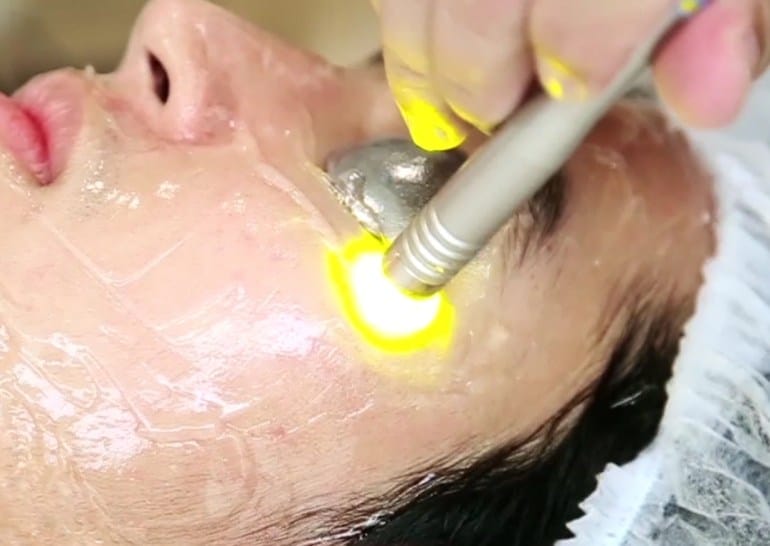 Điều trị mạch máu da bằng laser đồng