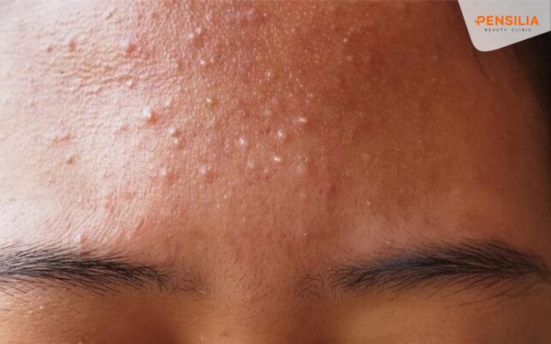 cách trị mụn đầu trắng