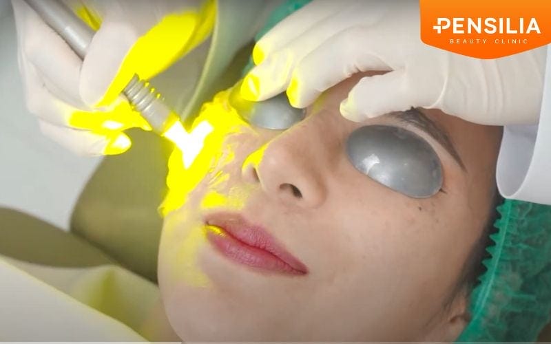 Công nghệ Laser đồng tại Pensilia