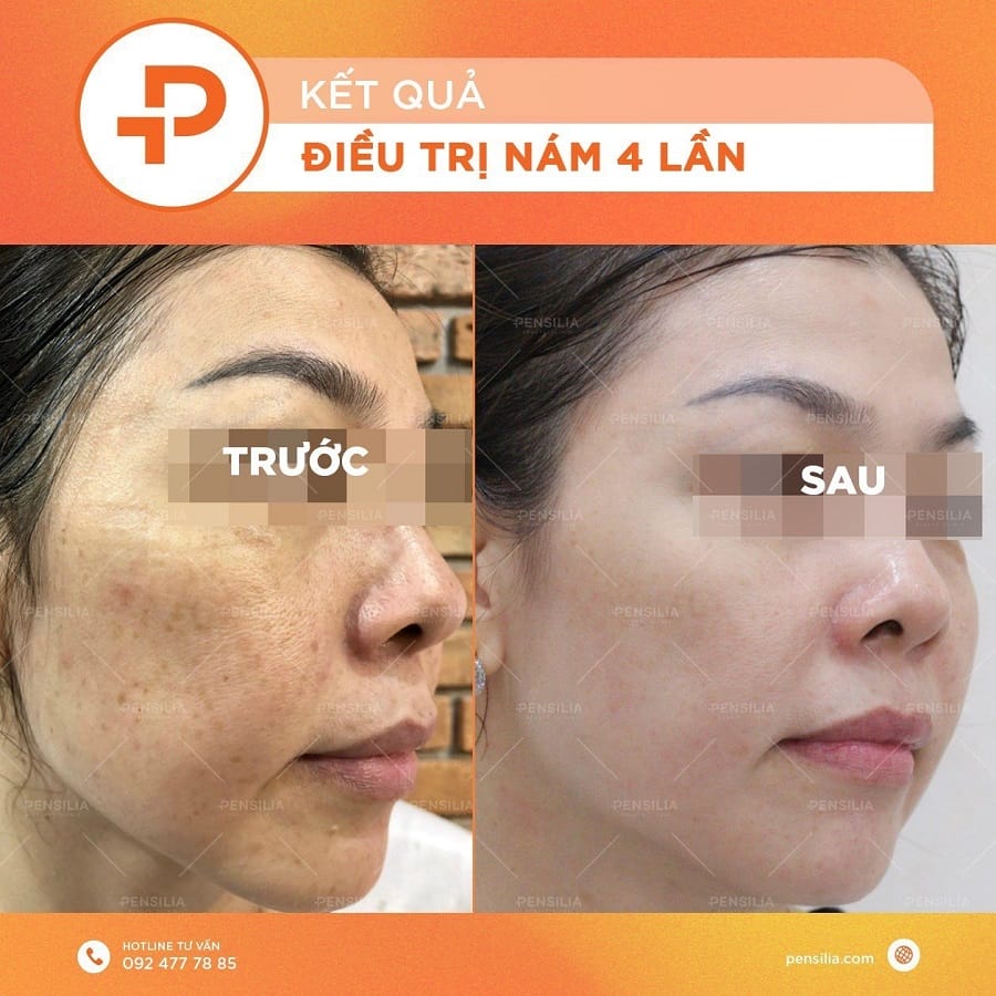 Hiệu quả điều trị nám da tại Pensilia