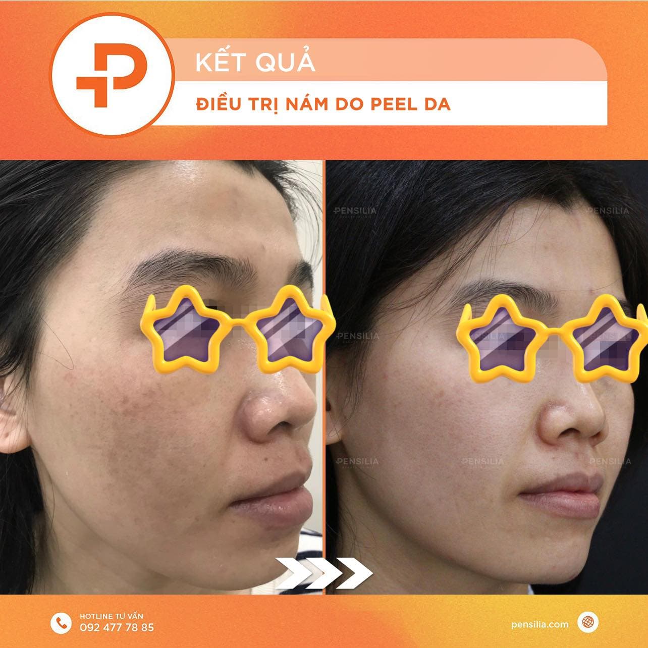 Điều trị nám tái phát