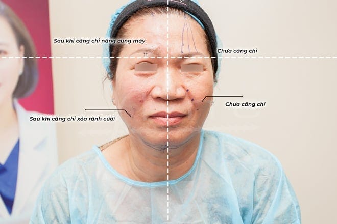 Căng chỉ là giải pháp trẻ hóa toàn diện